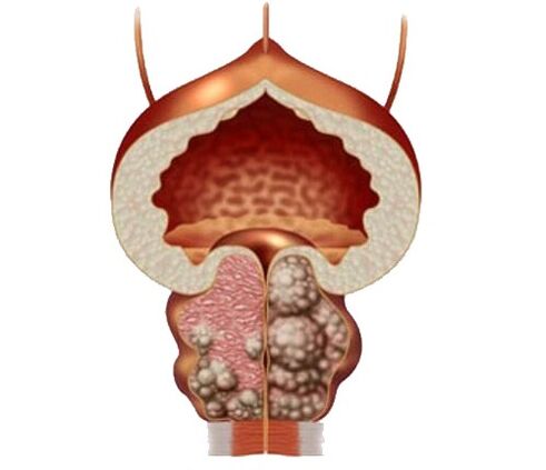Adenom a edém prostaty a liečba kapsúl Urosaf