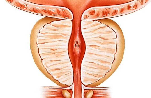 prostatitída
