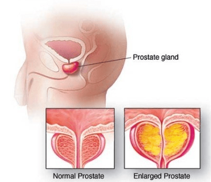 Normálna a zapálená prostata