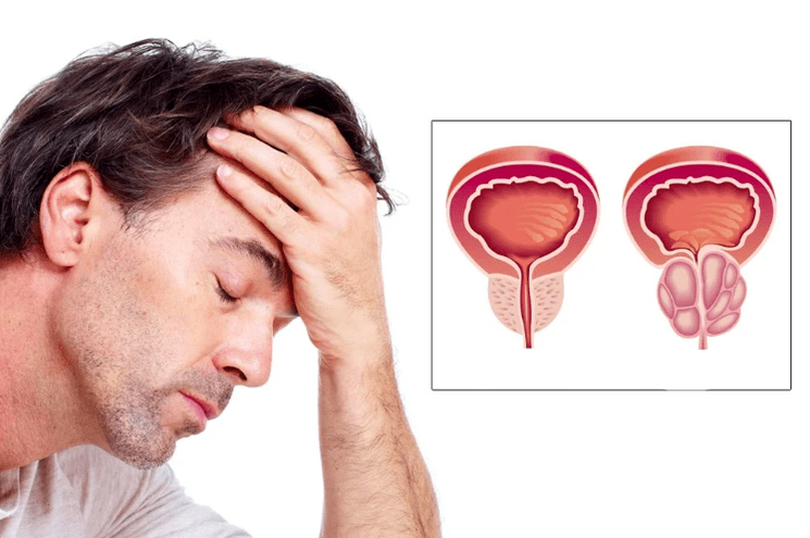 Zdravé a zapálené prostatu u mužov